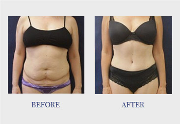 Breast Asymmetry Correction in Vancouver