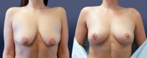 Breast Lift Patient 01