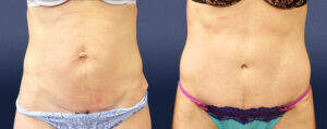 Abdominal Contouring Patient 01