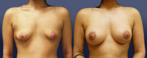 Tuberous Patient 02