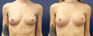Breast Augmentation Patient 01