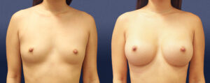 Breast Augmentation Patient 02