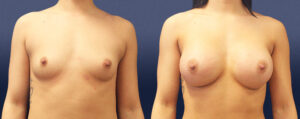 Breast Augmentation Patient 03