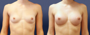 Breast Augmentation Patient 04