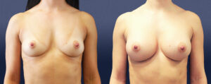Breast Augmentation Patient 08