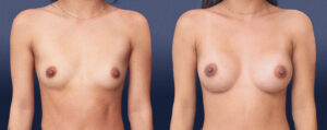 Breast Augmentation Patient 12