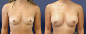 Breast Augmentation Patient 13
