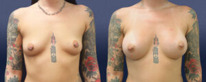 Breast Augmentation Patient 14
