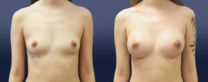 Breast Augmentation Patient 15