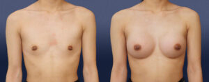 Breast Augmentation Patient 16