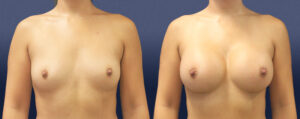Breast Augmentation Patient 19