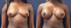 Breast Augmentation Patient 20