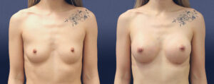 Breast Augmentation Patient 21