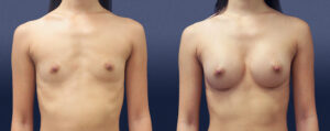 Breast Augmentation Patient 22