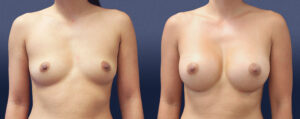 Breast Augmentation Patient 24