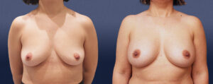 Breast Augmentation Patient 23
