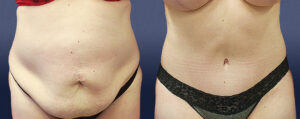 Abdominoplasty Patient 01
