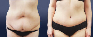 Abdominoplasty Patient 02