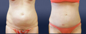 Abdominal Contouring Patient 02