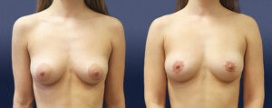 Areolar Reduction Patient 01