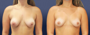 Areolar Reduction Patient 06