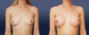 Breast Asymmetry Patient 03