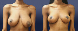 Breast Asymmetry Patient 04