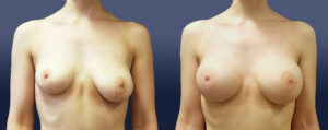 Breast Asymmetry Patient 05