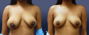 Breast Asymmetry Patient 07