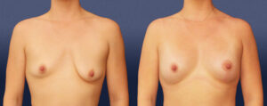 Breast Asymmetry Patient 02