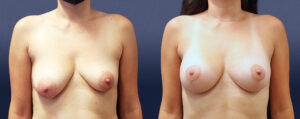 Breast Asymmetry Patient 01