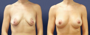 Breast Augmentation With Lift Patient 03