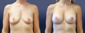 Breast Augmentation With Lift Patient 04