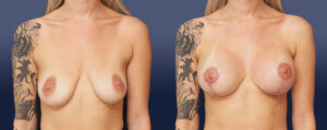 Breast Augmentation With Lift Patient 05