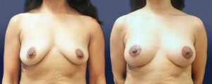 Breast Augmentation With Lift Patient 06