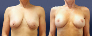Breast Augmentation With Lift Patient 08