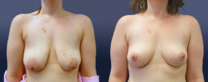 Breast Lift Patient 10