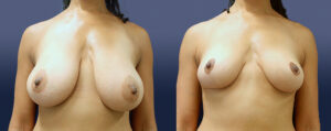 Breast Lift Patient 14