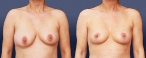 Breast Lift Patient 04