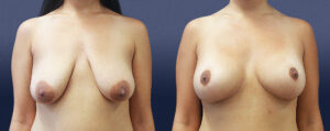 Areolar Reduction Patient 03