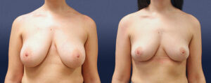 Breast Lift Patient 06