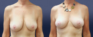 Breast Lift Patient 08