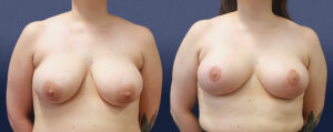 Breast Lift Patient 09