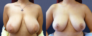 Breast Reduction Patient 09