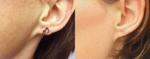 Earlobe Repair Patient 01