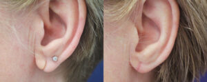 Earlobe Repair Patient 02