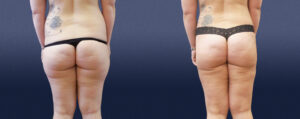 Liposuction Patient 02