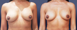 Nipple Reduction Patient 02