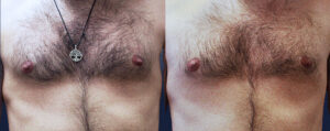 Nipple Reduction Patient 03