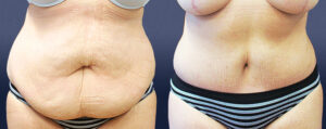 Abdominoplasty Patient 03